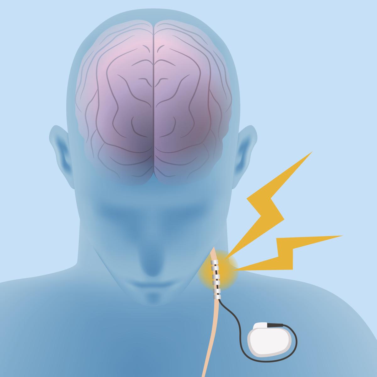 Man with neuromodulation device stimulating nerve