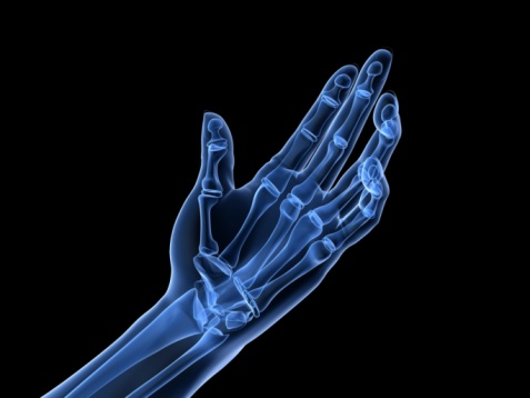 Hand x-ray - arthritis