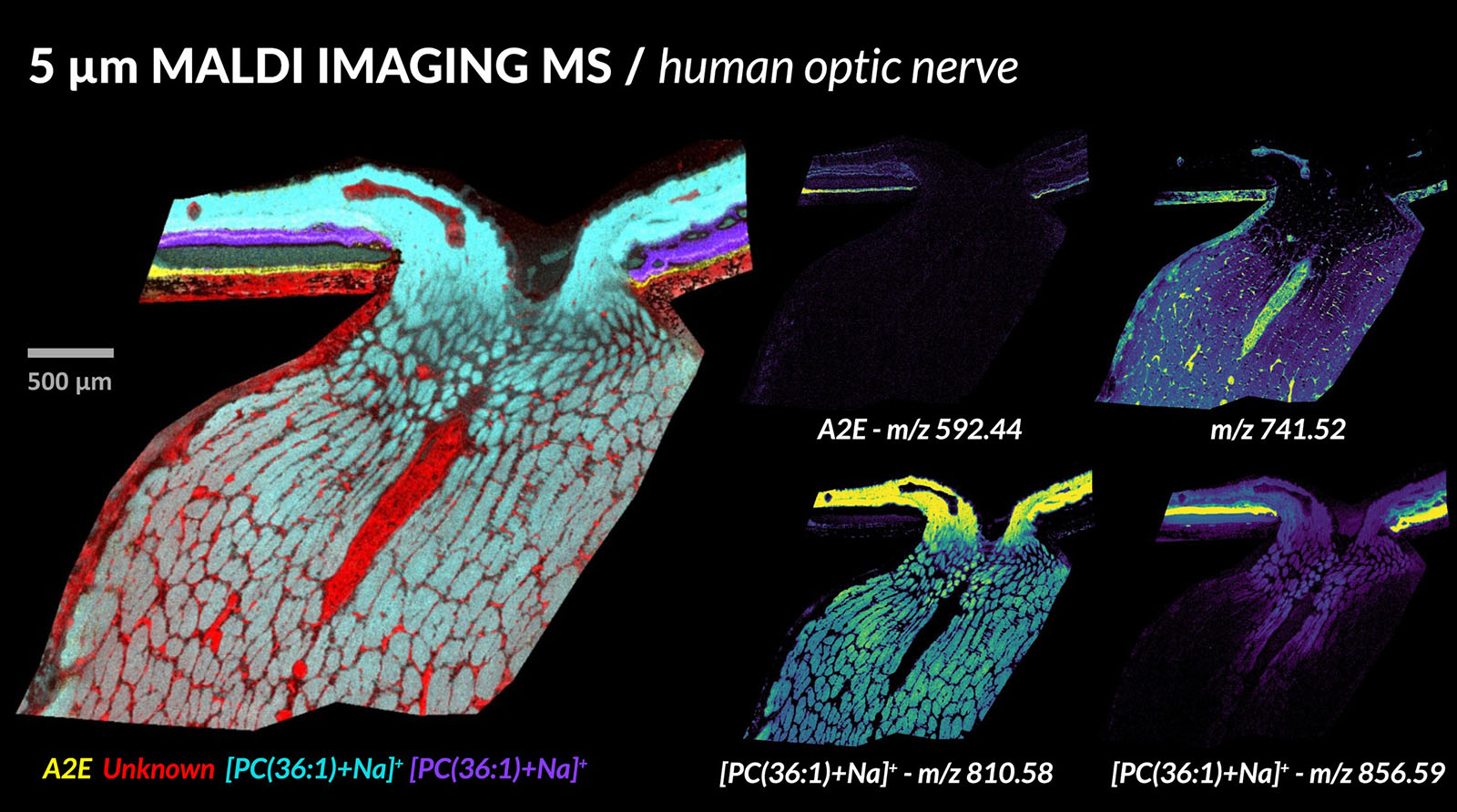 MALDI image of human optic nerve, courtesy of Dave Anderson from Vanderbilt