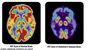 PET scan of normal brain and Alzheimer's brain