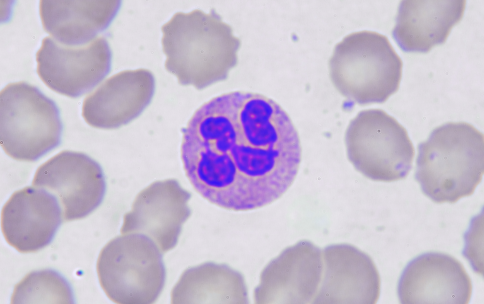 A pink, round neutrophil cell surrounded by opaque grey blood cells. The neutrophil has a dark purple, multi-lobed nucleus.
