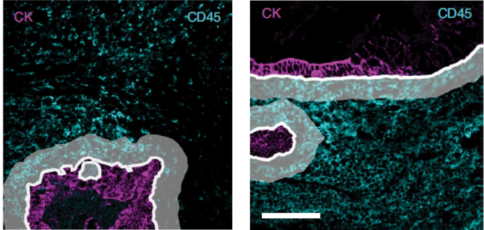Image of immune cells surrounding colorectal tumor cells. Magenta cells are displaying enriched expression in immune cells, while cyan cells are showing decreased expression in immune cells within the border.